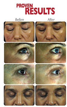 Dermafrac Dermafrac