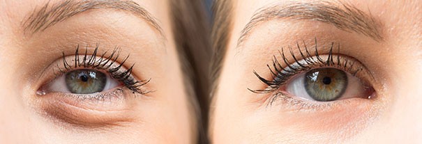 Tear Through Fillers Tear Through Fillers
